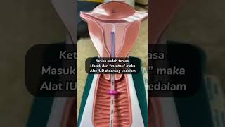 CARA MEMASUKAN KB IUD KEDALAM RAHIM!! | KB SPIRAL DALAM RAHIM! #kb #kbiud #tipskbiud #kbspiral screenshot 1