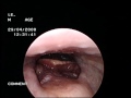 Cancer of the tonsil - www.drjeeve.com