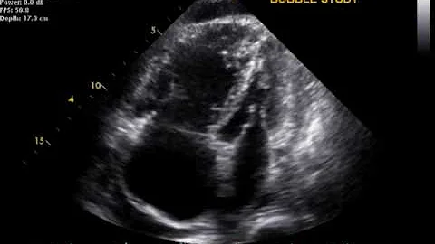 Pulmonary Hypertension echo