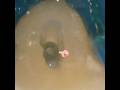 Management of severly calcified root canal of 42,#calcification #rootcanal #rct #endo