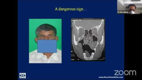 AIOC2021- GP151- Topic - Dr.Muralidhar - How  when and what of paralytic strabismus