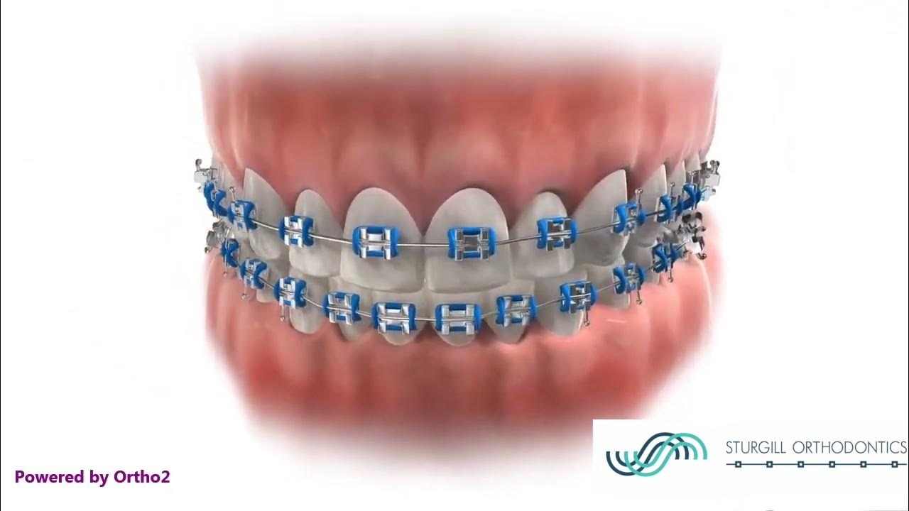 Sturgill Orthodontics Braces Tips Brushing Instructions YouTube