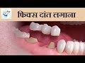 फिक्स दांत लगाना | Dental Bridge in Hindi