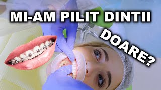 Mi Am Pus Aparat Dentar Invizibil - Feedback Dupa 2 Luni + Curiozitati (Part 1)