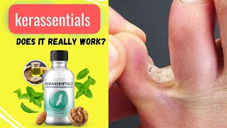 Does kerassentials really work? || kerassentials for toenail fungus
