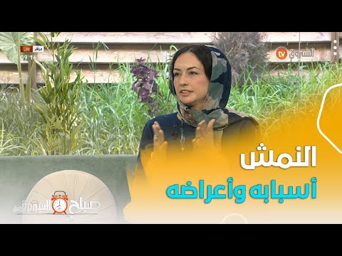 تعرف مع الطبية المختصة في أمراض الجلد على النمش أسبابه وأعراضه