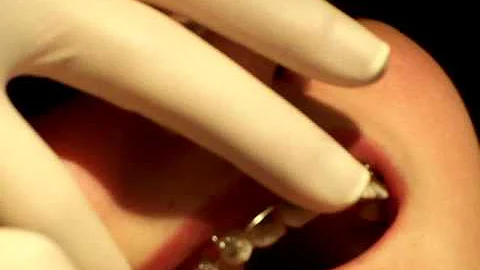 Braces Step-by-Step: Step-18 Eighth Month Appointm...