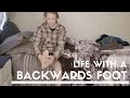 Rotationplasty: Life With a Backwards Foot