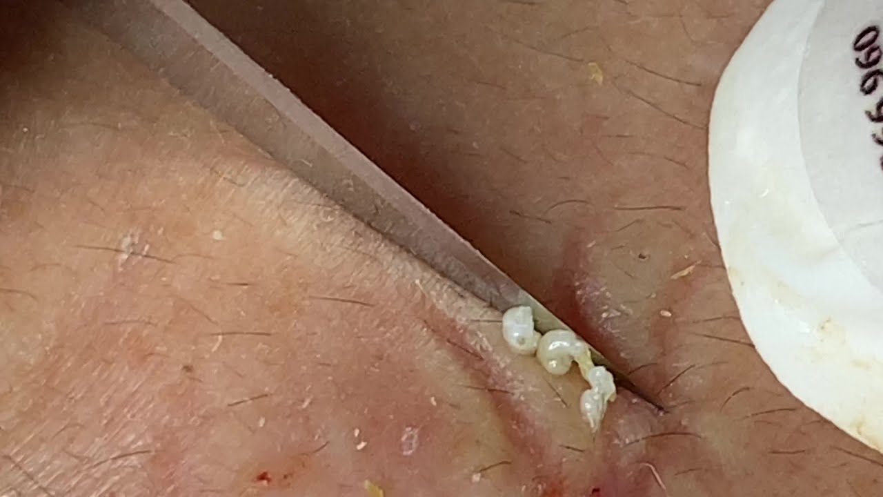 Squeezing blackheads efficiently | Nặn Mụn Nhanh Hiệu Quả -  SacDepspa#123