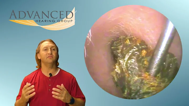 "Shocking Truth About Q-Tips! The Ear-Cleaning Danger You Never Knew EARWAX REMOVAL VLOG#76