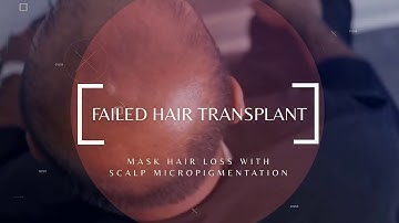 Restore FUE Hair Transplant with Scalp Micropigmentation by Unyozi Beauty in Toronto