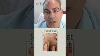 Before & After: Real Results – Laser Treatment for Pilonidal Cysts Part 3