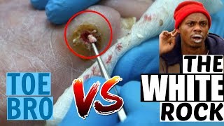 GOUT PAIN RELIEF-Removing Gout Crystals From a Baby Toe!!! COMPLETE TREATMENT!!!