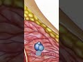 Breast Biopsy Wire Localization: Step-by-Step Guide 🏥 🎥 PreOp® #PreOp #Shorts #BreastBiopsy