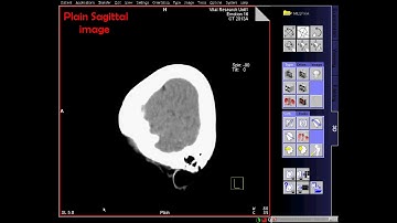 CT Normal Brain Axial, Coronal &  Sagittal video