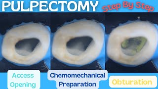 Pulpectomy ⚪️ Step By Step Demonstration 🔵 Baby Blue Pediatric Rotary Endodontic Files