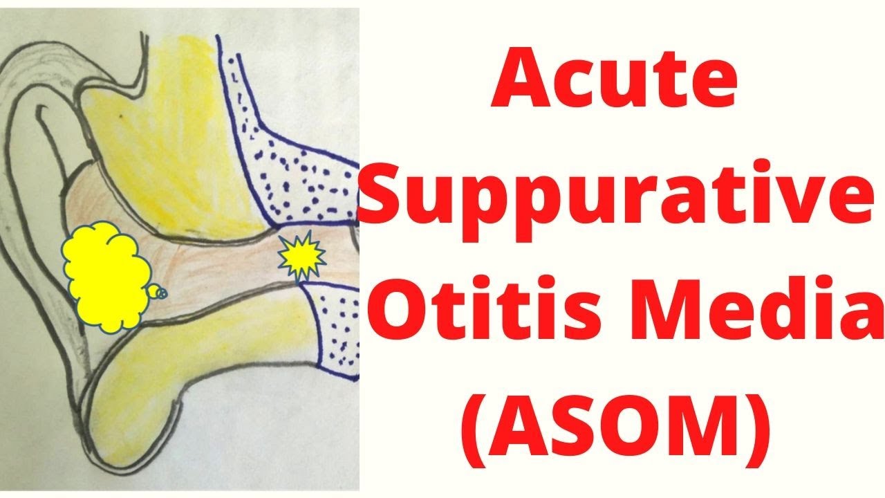 Acute Suppurative Otitis Media Asom Middle Ear Infection Causes For