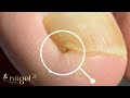 ELA BATEU O DEDO E A UNHA FINCOU ALI (veja como remover a unha dura e fincada) #satisfying #nails