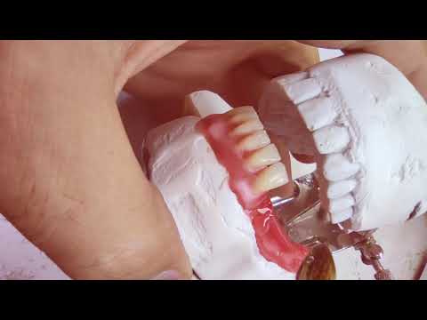 Video: Diş Protezləri Necə Saxlanılır