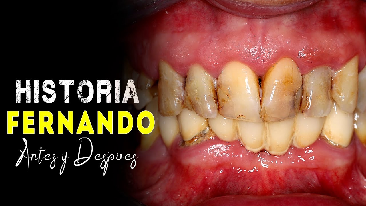 ✅Carga INMEDIATA en IMPLANTES DENTALES 👉Protesis dental FIJA COMPLETA en 24H🤗 implantes dentales problemas