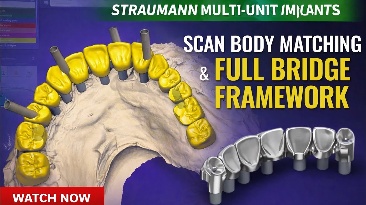 Straumann Multi Scan Body Straumann Multi-Unit Implant Digital Workflow | Scan Body Matching ...