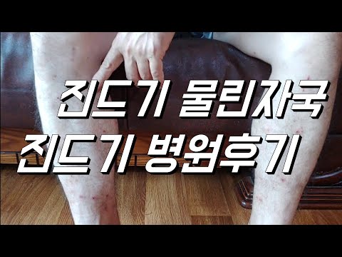 진드기 물린자국. 진드기 가려움. 피부과 후기