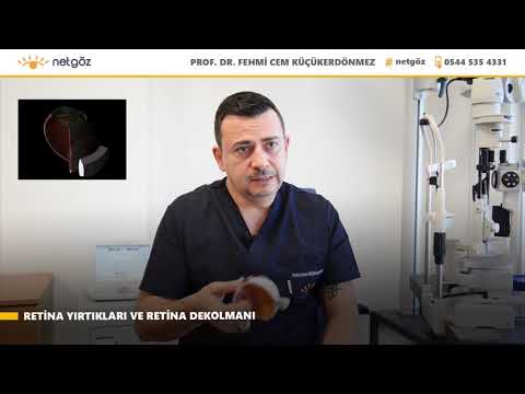 Prof. Dr. Fehmi Cem Küçükerdönmez - Retina Yırtığı, Retina Dekolmanı