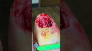 Left Toenail removal (WARNING GRAPHIC)