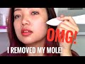 I REMOVED MY MOLE WITH THE WARTS REMOVAL PEN! OMG...