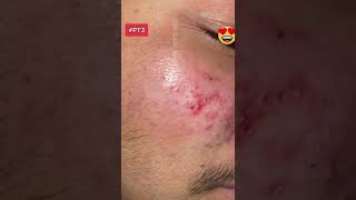 70 Topurchaseblackheadextractiontoolkitlinkinmybio