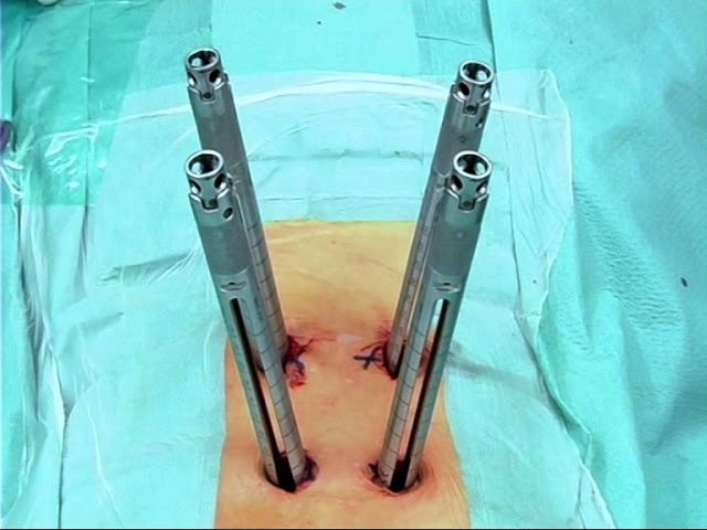 Применение MIS транспедикулярной системы VENUS® mini - live surgery