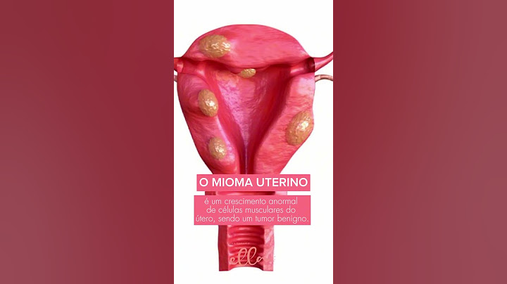 O Mioma Uterino