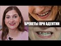 БРЕКЕТЫ. МОЯ ИСТОРИЯ.