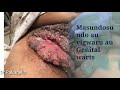 GENITAL WARTS MASUNDOSUNDO GENITAL WARTS MASUNDOSUNDO