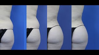 Brazilian Butt Lift Results For Every Body Type By Dr. Dass Beverly Hills