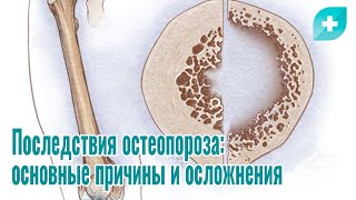 Последствия остеопороза: основные причины и осложнения