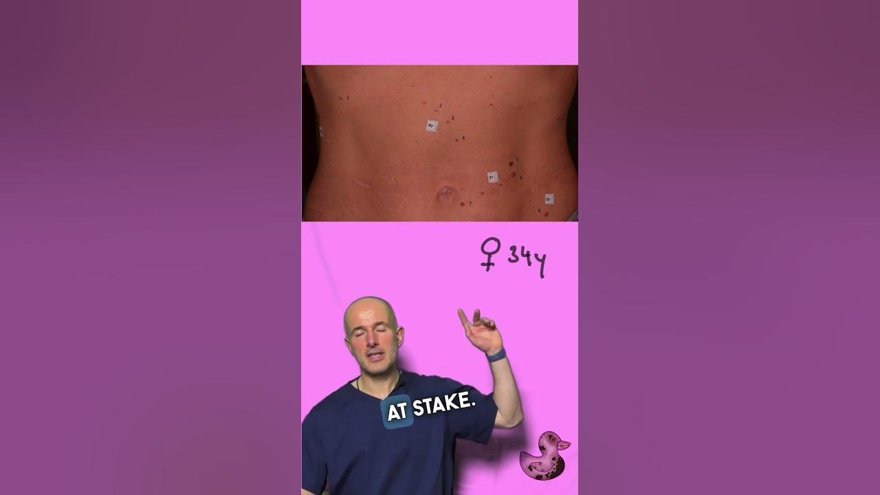 A shocking melanoma case guess which is the dangerous melanoma 