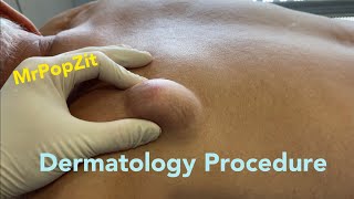 Dermatology procedure on back. MrPopZit.