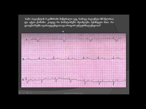 სამი პაციენტის ეკგ/ ფრედერიკის სინდრომი / გულის გამტარი სისტემის იდიოპათიური ფიბროზი / ბლოკადები