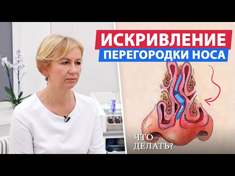 Как лечится искривление носовой перегородки?