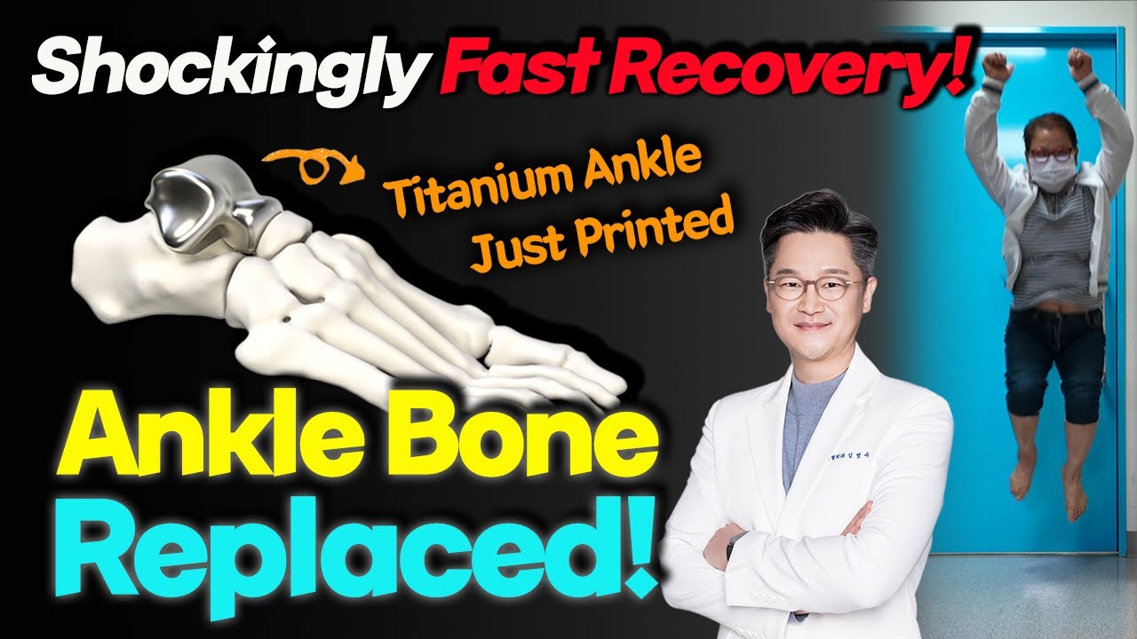 Walking in Weeks! Feels like Normal Ankle! Surprisingly Fast Recovery. Minimally Invasive