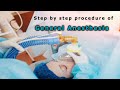 General anesthesia    step by step procedure