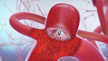 MicroVention WEB System Animation