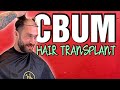 Why Would Chris Bumstead Get A Hair Transplant?