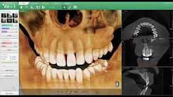 Pax-i 3D - панорамный аппарат с функцией компьютерного томографа