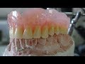 Como se hace una Placa #dental superior, el resultado sorprendente