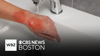 How to properly treat a burn at home