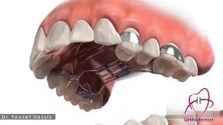 دكتور يوسف قصيص: جهاز توسيع الفك العلوي السريع...