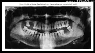 Trigeminal Herpes Zoster