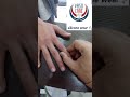 Cosmetic Silicone Finger Prosthesis اصابع سيليكون تجميلي 